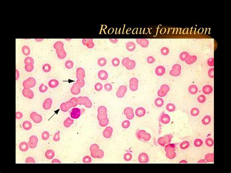 rouleaux formation in multiple myeloma.